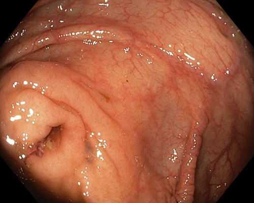 胃癌图片 (7)