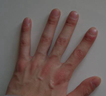 手指关节肿大图片 (27)