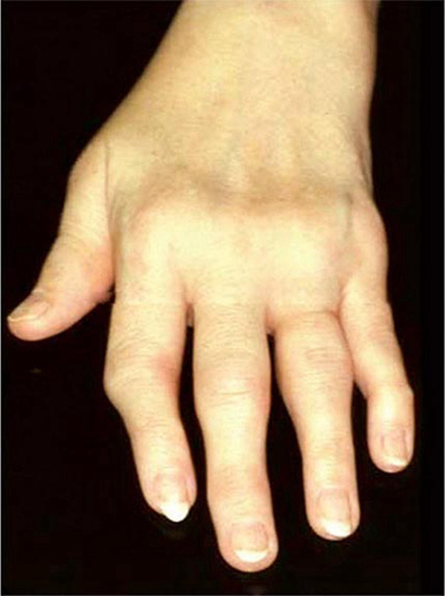 手指关节肿大图片 (40)