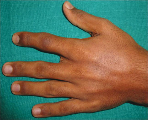 手指骨质增生症状图片图片