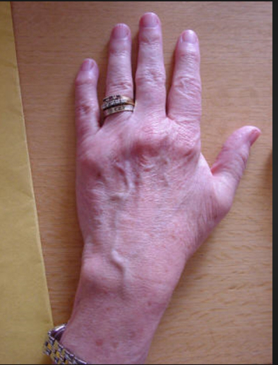 手指关节肿大图片 (49)