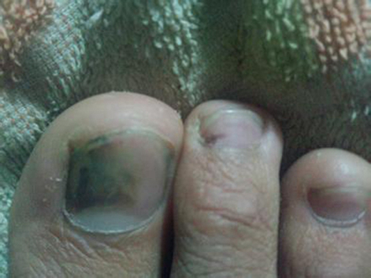 灰指甲初期症状 (56)