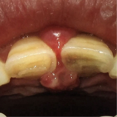 牙癌的症状和外部图片 (27)