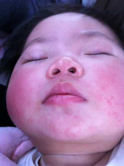 小儿麻疹图片初期症状图片