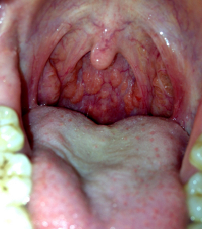 咽喉癌图片 症状早期图片