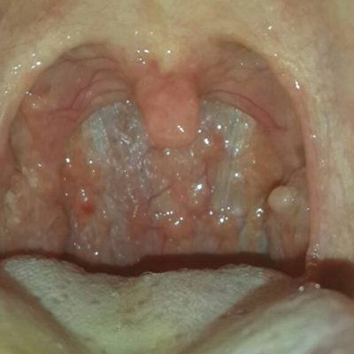 喉咙长了个囊肿图片 (5)