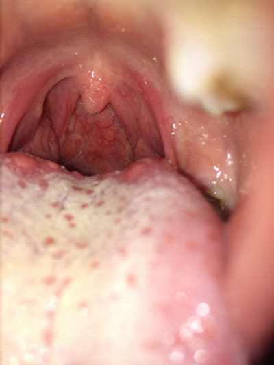 喉咙长了个囊肿图片 (52)
