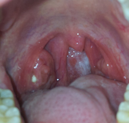 喉咙长了个囊肿图片 (60)