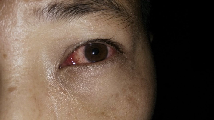 眼癌的早期症状图片 (13)