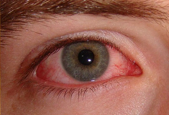 眼癌的早期症状图片 (19)