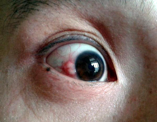 眼癌的早期症状图片 (40)
