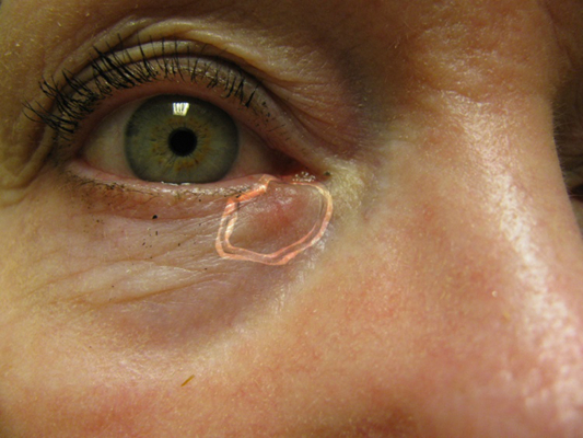 眼眶畸胎瘤图片