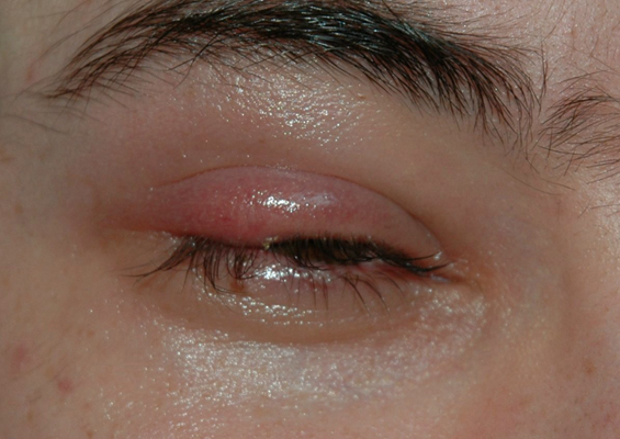 眼癌的早期症状图片 (65)