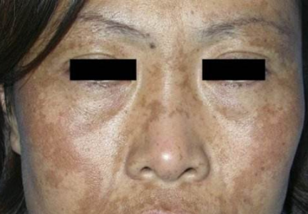 脸上肝斑图片 (49)