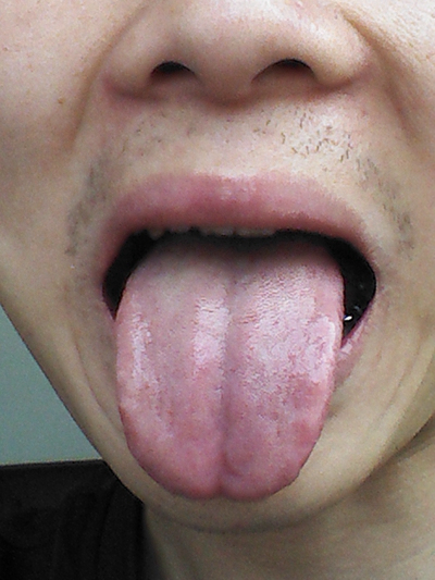 舌头发紫图片50