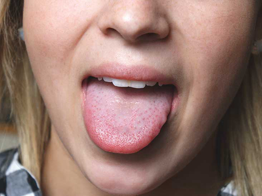 舌头紫斑图片图片