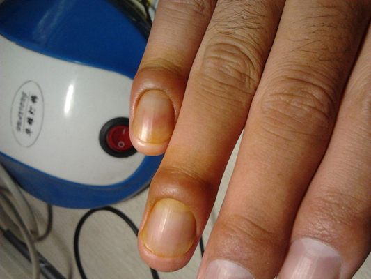 严重缺钙手指甲图片图片