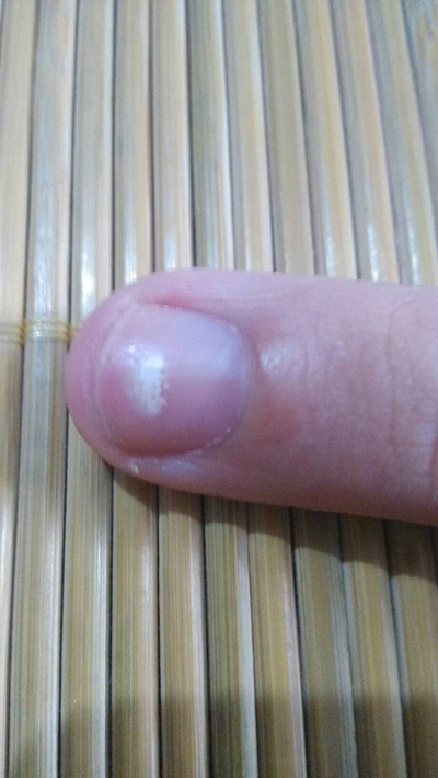 缺钙指甲图片8