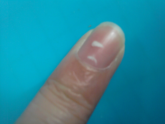 缺钙指甲图片 (8)