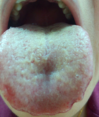 舌头苔癣早期图片图片