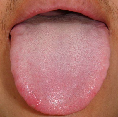 艾滋病的舌头前兆图片图片