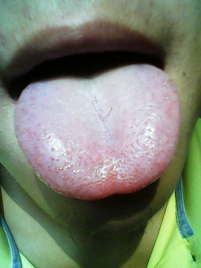 艾滋病的舌头白苔图片 (1)