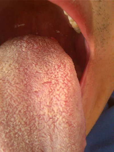 艾滋病舌头白斑图片图片