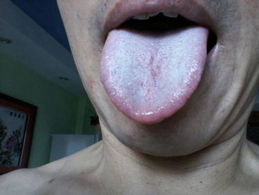 艾滋病舌头症状图片图片