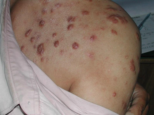 梅毒初期红疹图片图片