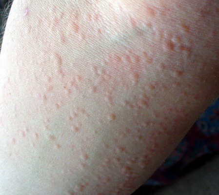 季节性荨麻疹症状图图片