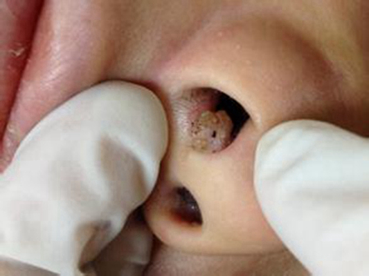 儿童鼻炎内部图片图片