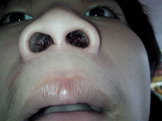 鼻炎鼻孔照片鼻子图片