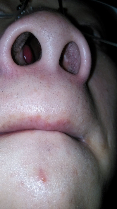 鼻窦炎症状图片 (44)
