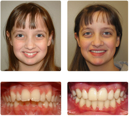 天包地和正常牙齿区别图片