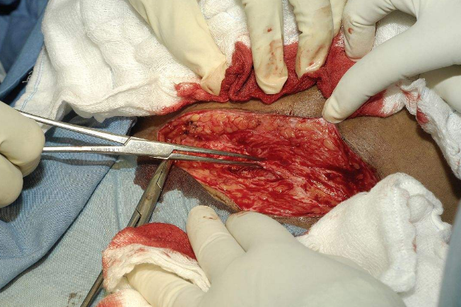 剖腹产手术 (9)