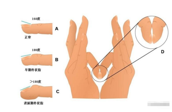手指关节肿大图片 (1)