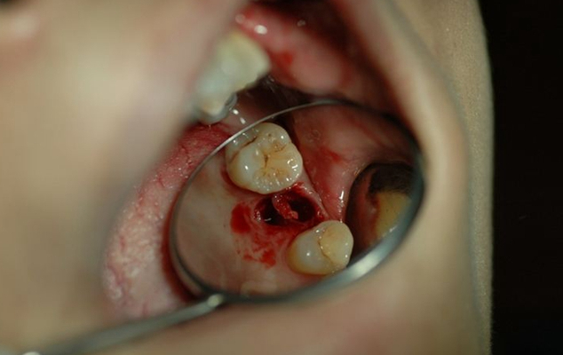 拔牙过程图片 (18)