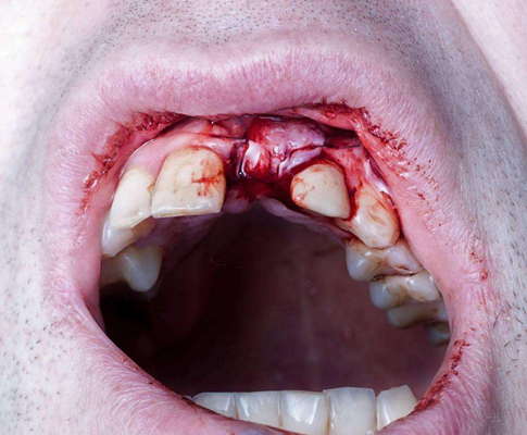 拔牙过程图片 (29)