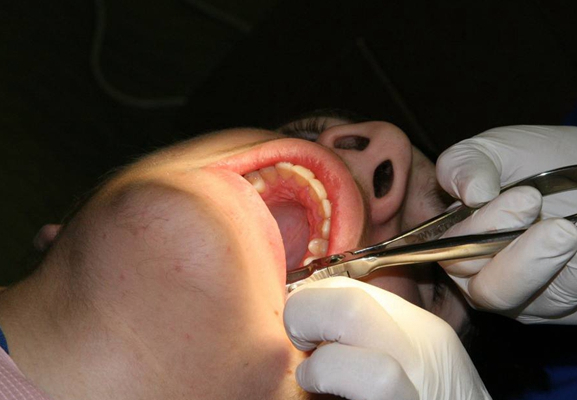 拔牙过程图片 (8)