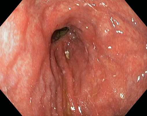 胃癌图片 (40)