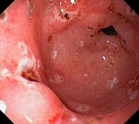 胃癌图片 (65)