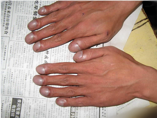手指关节肿大图片 (28)