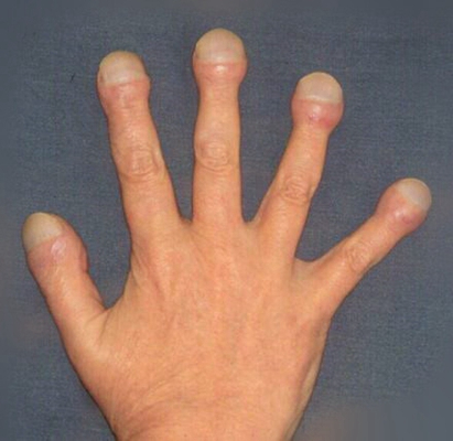 手指关节肿大图片57