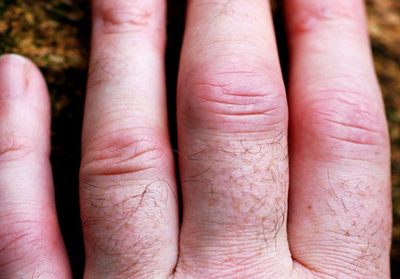 手指关节肿大图片 (41)