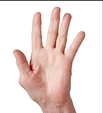 手指关节肿大图片 (47)