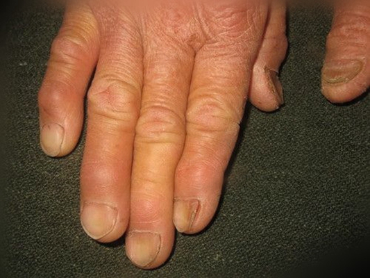 手指关节肿大图片 (5)