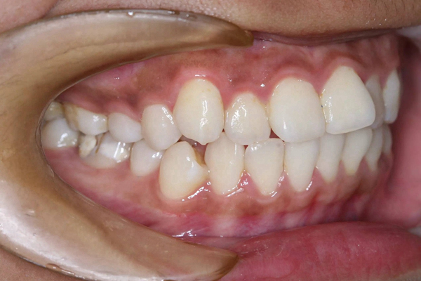 牙癌的症状和外部图片 (2)