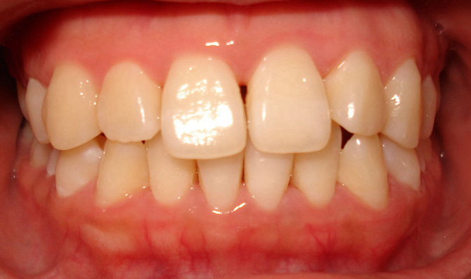 牙癌的症状和外部图片 (25)