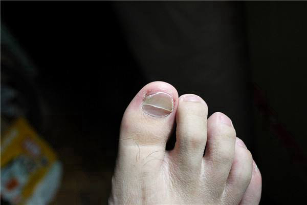 灰指甲初期症状 (9)