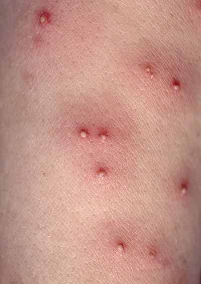 eb病毒的前期皮疹图片图片